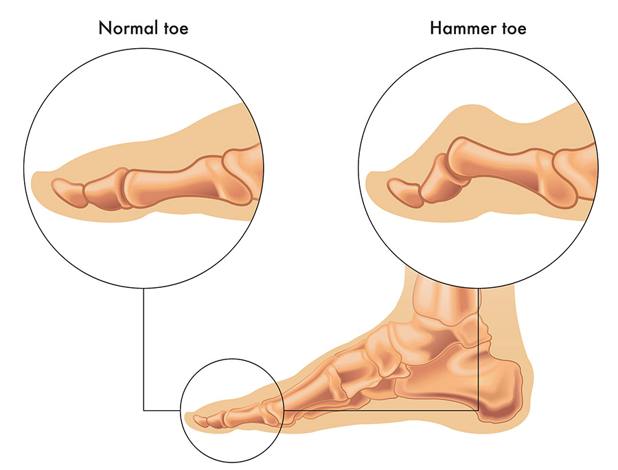 Medical illustration shows the difference between a normal toe and a hammer toe