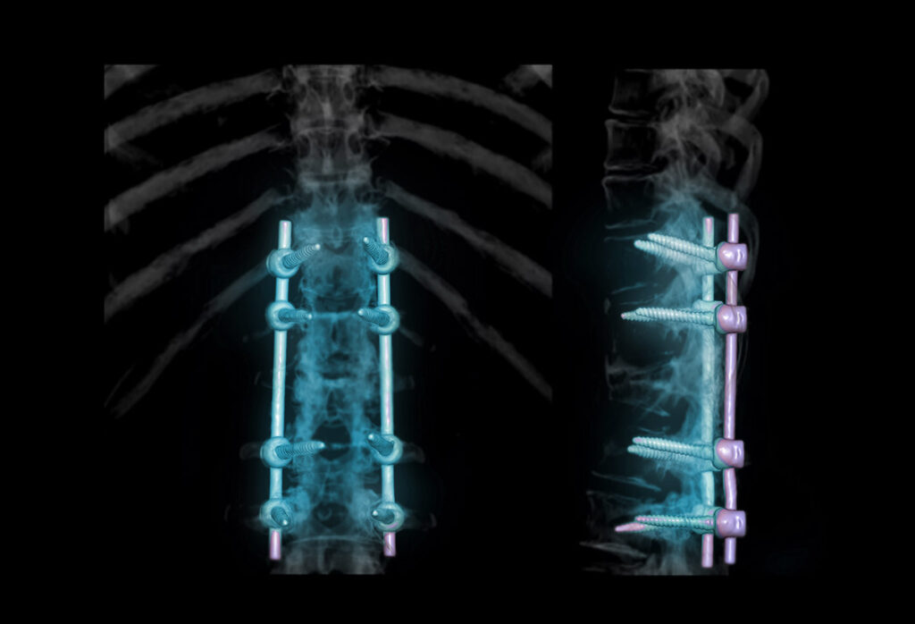 x-ray of the lumbar region of the spine, after decompression and spinal fusion to assist.